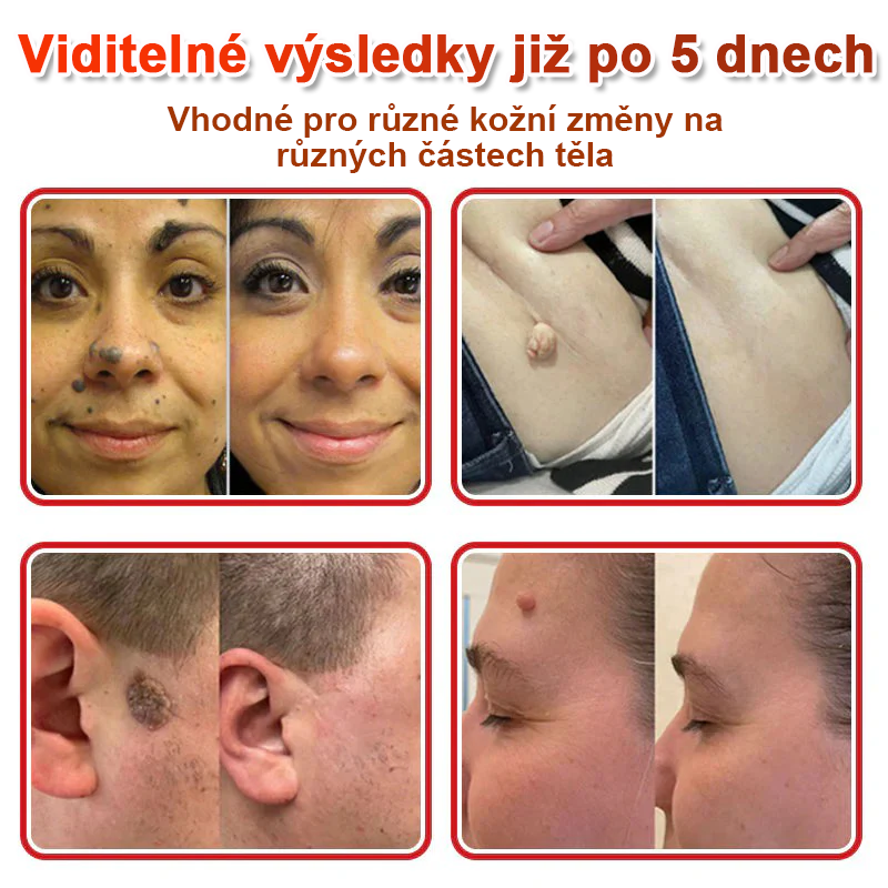 TLOPA® Mikrovpichová botanická náplast na odstranění kožních výrůstků 🇨🇿 Vyrobeno v Česká republika🎁