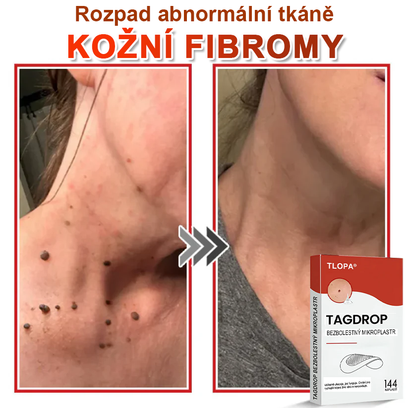 TLOPA® Mikrovpichová botanická náplast na odstranění kožních výrůstků 🇨🇿 Vyrobeno v Česká republika🎁