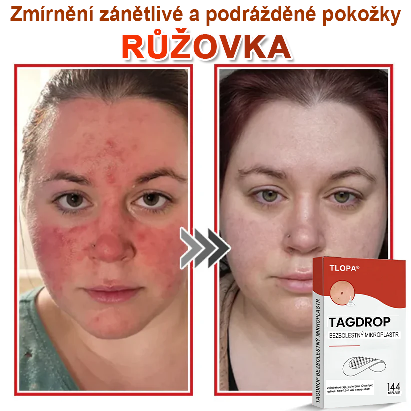TLOPA® Mikrovpichová botanická náplast na odstranění kožních výrůstků 🇨🇿 Vyrobeno v Česká republika🎁