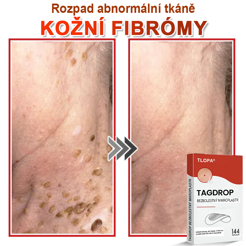 TLOPA® Mikrovpichová botanická náplast na odstranění kožních výrůstků 🇨🇿 Vyrobeno v Česká republika🎁