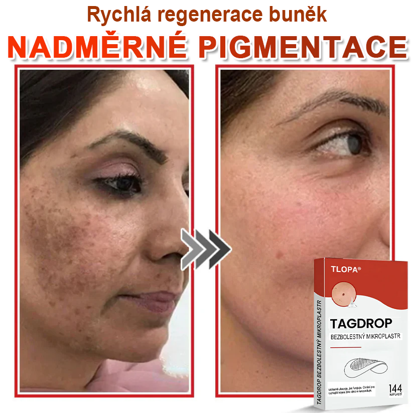TLOPA® Mikrovpichová botanická náplast na odstranění kožních výrůstků 🇨🇿 Vyrobeno v Česká republika🎁