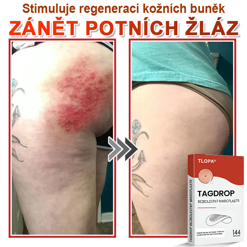 TLOPA® Mikrovpichová botanická náplast na odstranění kožních výrůstků 🇨🇿 Vyrobeno v Česká republika🎁