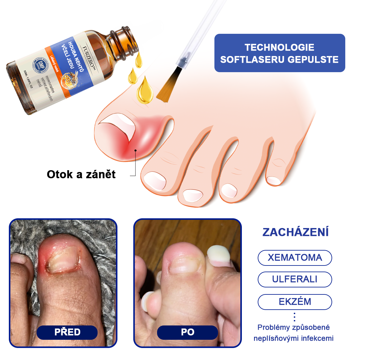 🐝🐝Furzero™ Včelí jed na plíseň nehtů: kompletní řešení plísně nehtů 🌟👣
