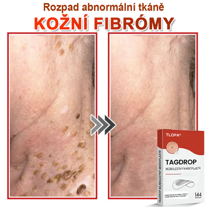 TLOPA® Mikrovpichová botanická náplast na odstranění kožních výrůstků 🇨🇿 Vyrobeno v Česká republika🎁